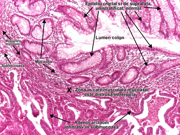 Adenocarcinomul moderat diferentiat (colon)