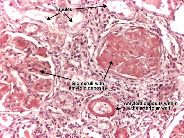 Amyloidosis kidney
