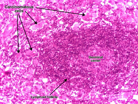 Carcinoma metastasis (lymph node)