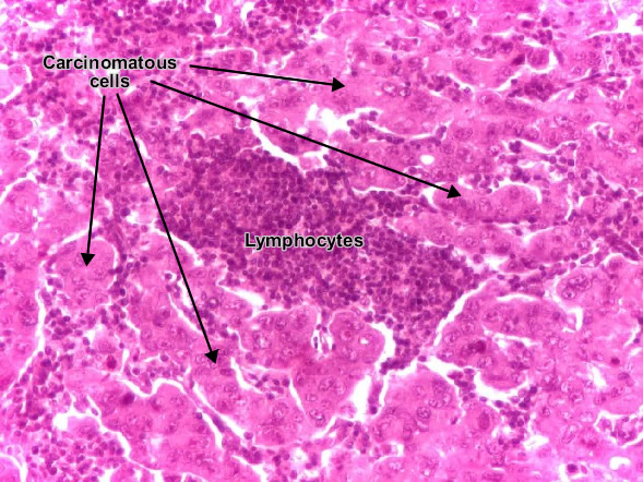 Carcinoma metastasis (lymph node) - detail