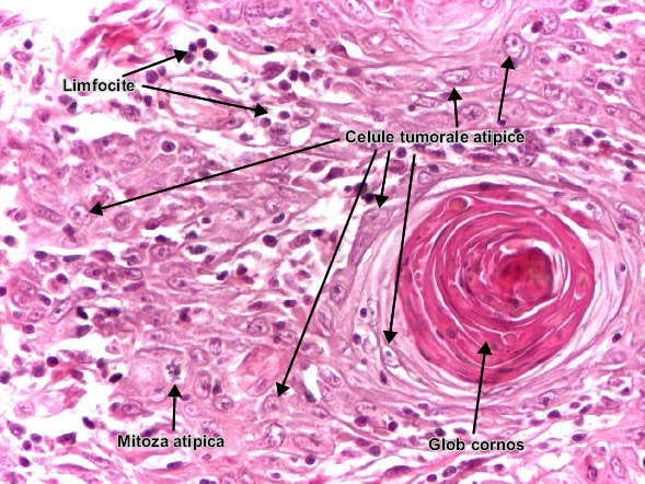 Carcinomul scuamocelular keratinizat - detaliu