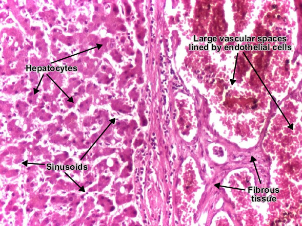 Cavernous hemangioma liver (detail)
