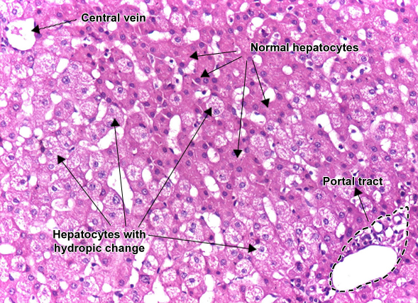 Cellular swelling liver