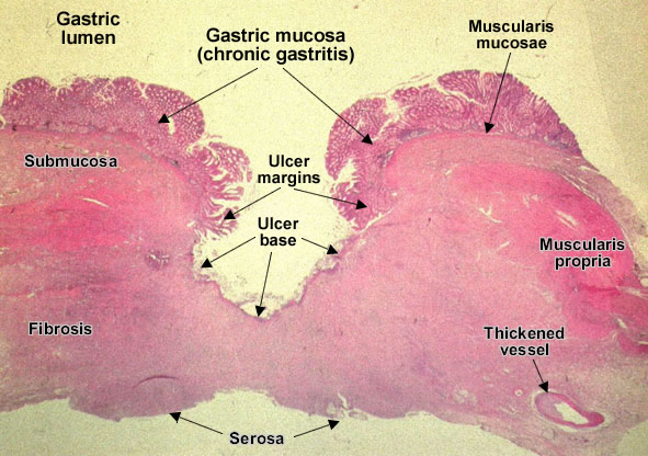 Chronic peptic ulcer - section