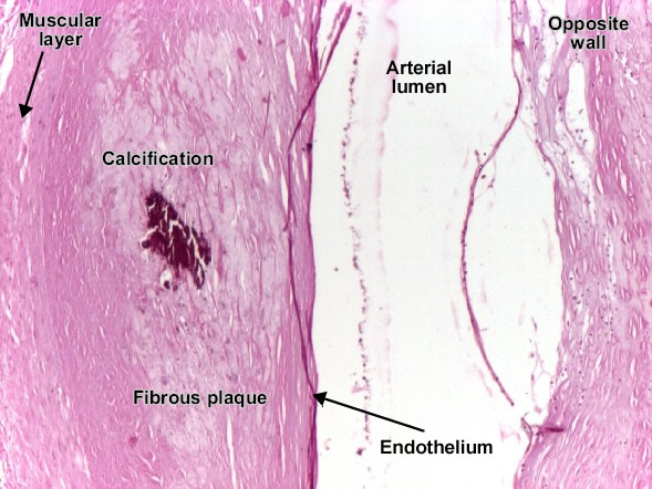 Coronary atherosclerosis - the fibrous plaque with calcification