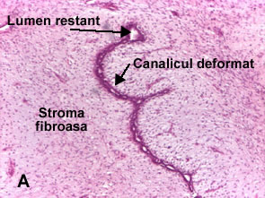 Fibroadenom glanda mamara intracanalicular (I)