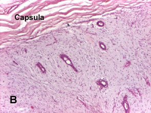 Fibroadenom glanda mamara intracanalicular (2)