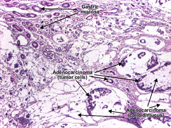 Gastric carcinoma diffuse type mucinous