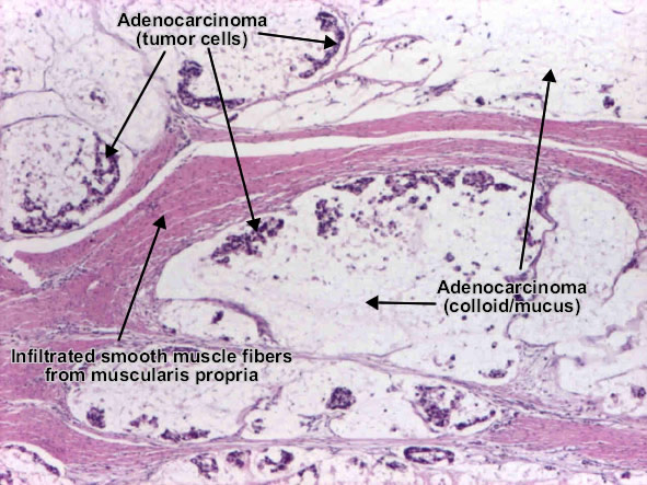 Gastric carcinoma diffuse type mucinous (detail)