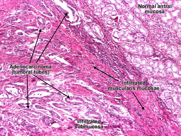 Gastric carcinoma intestinal type