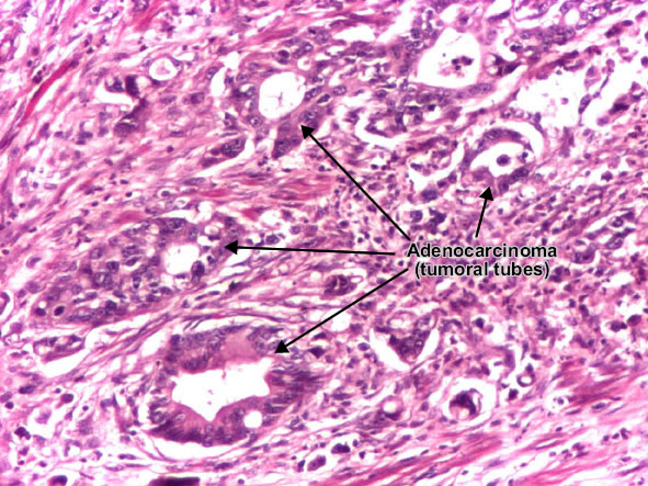 Gastric carcinoma intestinal type - detail