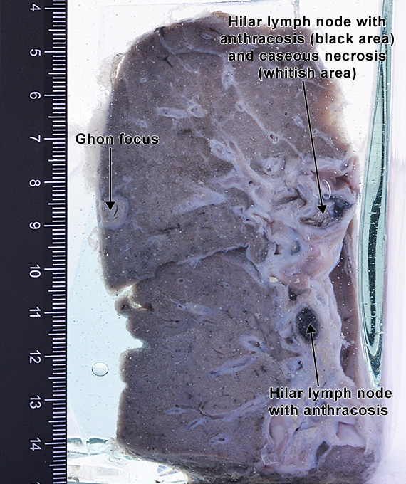 Ghon complex (primary tuberculosis