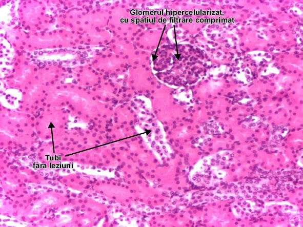 Glomerulonefrita acuta proliferativa difuza post-streptococica