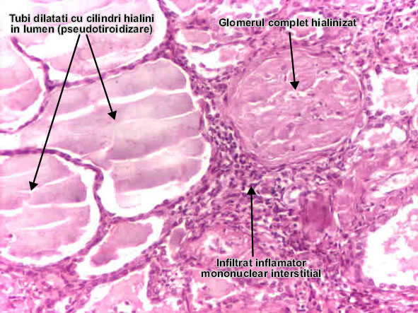 Glomerulonefrita cronica