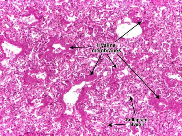 Hyaline membrane disease (Respiratory distress syndrome)