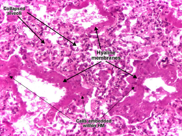 Hyaline membrane disease (Respiratory distress syndrome) (detail 1)