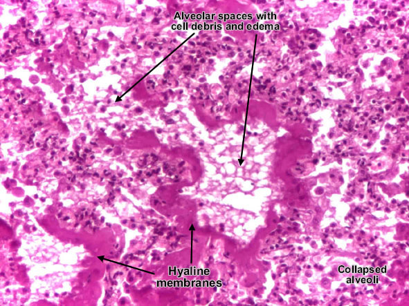 Hyaline membrane disease (Respiratory distress syndrome) (detail 2)