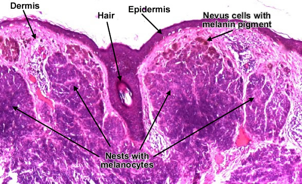 Intradermal melanocytic nevus