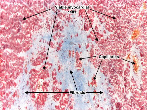 Ischemic fibrosis of myocardium