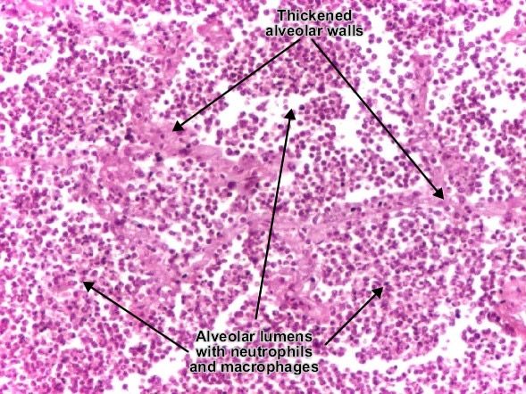 Lobar pneumonia (leukocytic alveolitis)