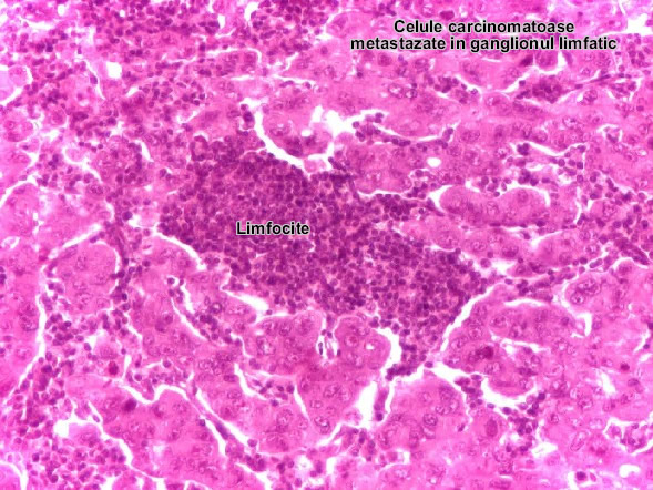 Metastaza de carcinom (ganglion limfatic)