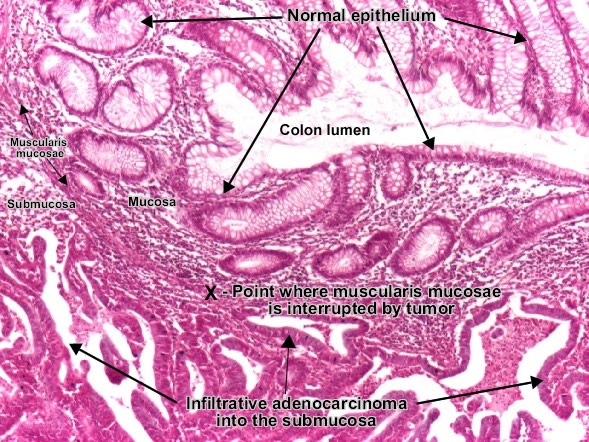 Moderately differentiated adenocarcinoma (colon)