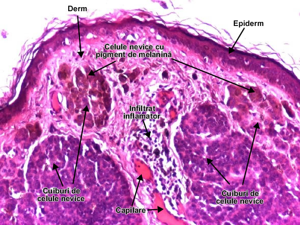Nevul melanocitar intradermic (detaliu)