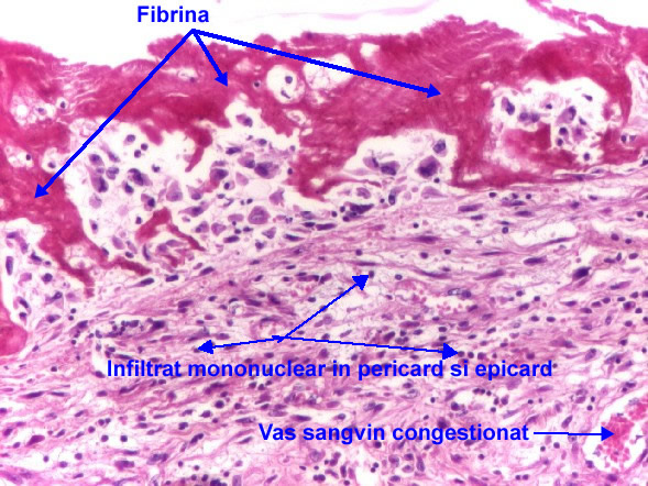 Pericardita fibrinoasa