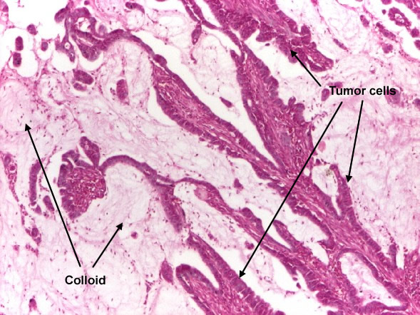 Poorly differentiated adenocarcinoma (mucinous), colon