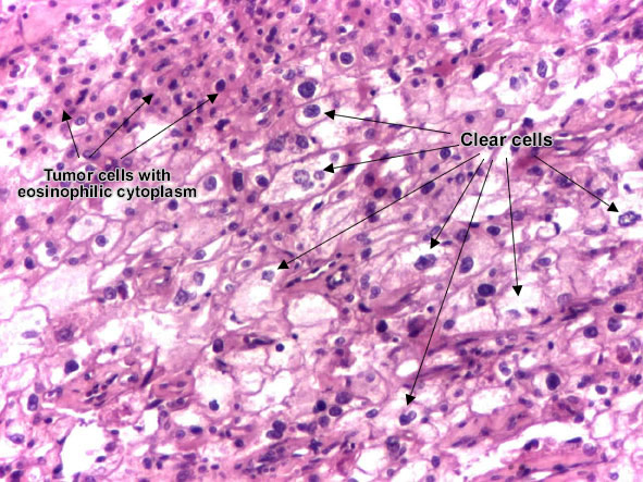 Renal cell carcinoma (Grawitz tumor)
