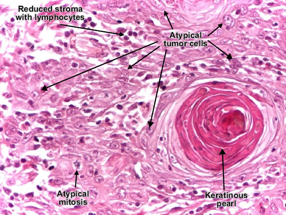 Squamous cell carcinoma (skin) - detail