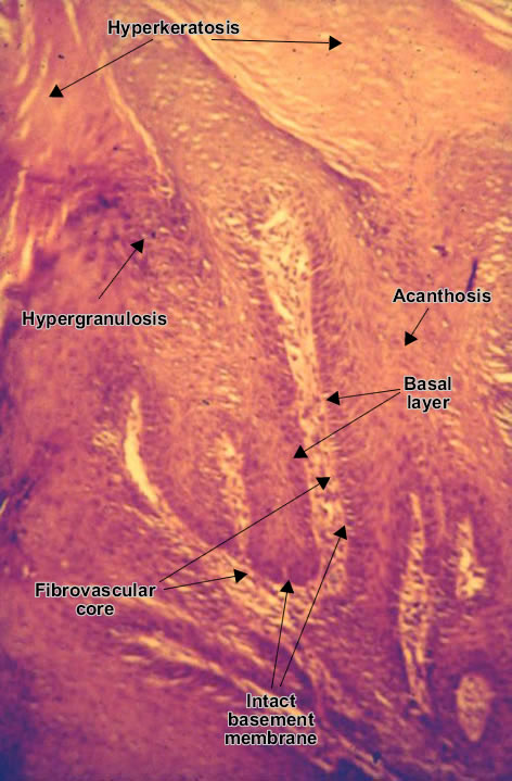 Squamous cell papilloma (skin)