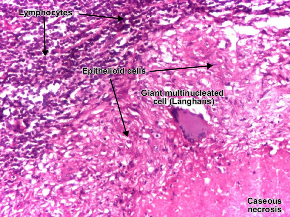 Tuberculous lymphadenitis (tuberculous granuloma)