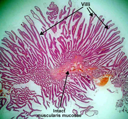 Villous adenoma sessile polyp colon